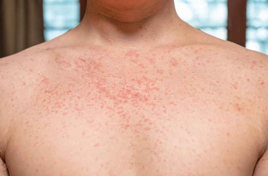 Measles Outbreak