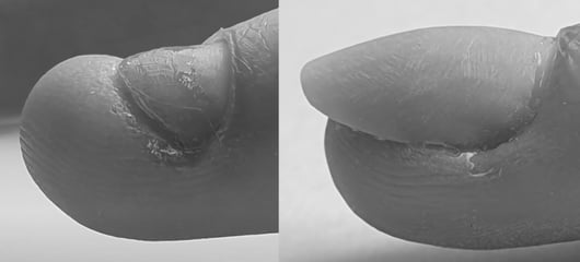 Treatment of bitten nails