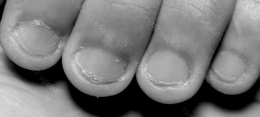 Bitten Nails