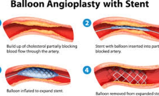 ballon angioplasty with stent
