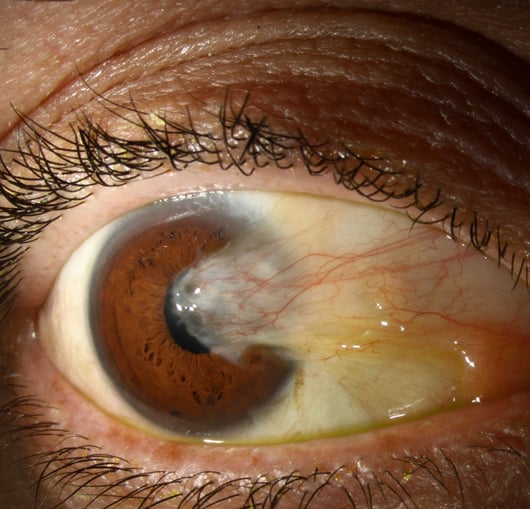 foto demonstrando o pterígio, carne crescida dos olhos, cirurgia de pterígio, olho seco