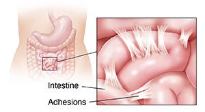 Adhesions GASTRO FOUNDATION