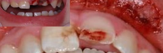 gum disease