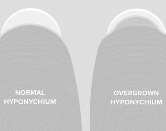 Overgrown hyponychium