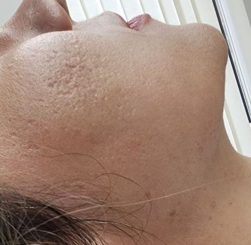 Acne scar
