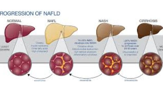 progression of liver fatty