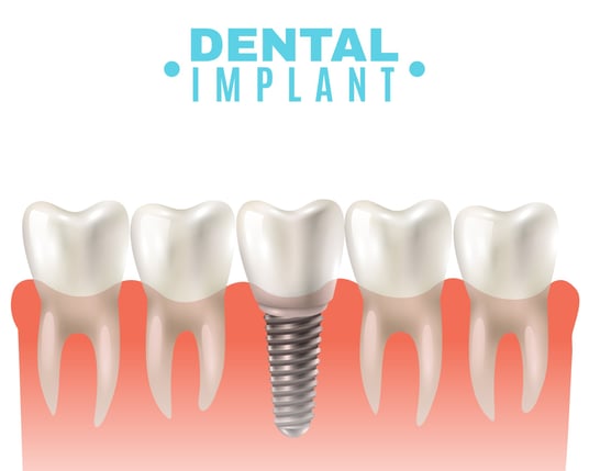 Best Dental Implants Clinic near me | Ekdantam Dental Clinic