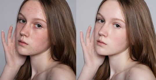 blemishes-and-scars-removal