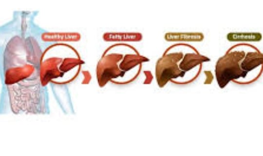 _Beware of the inevitable fate of fatty liver,fibrosis , cirrhosis, esophageal varices and hepatoma