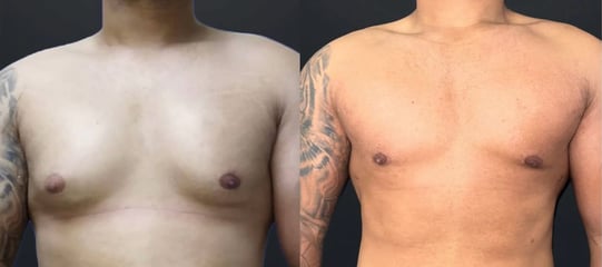 antes e depois ginecomastia 01