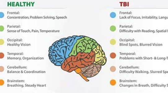 tbi