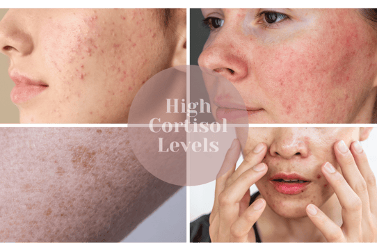 skin conditions linked to high cortisol