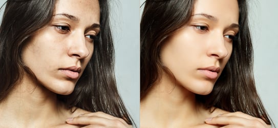 skin-refinement