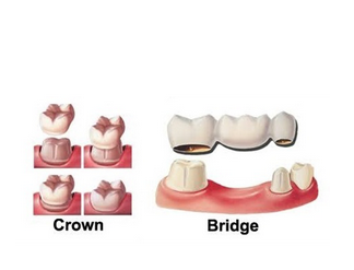 Best Dental Crowns and Bridges Treatments in Pune