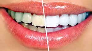 a image showing white teeth on one side andyellow teeth on other side