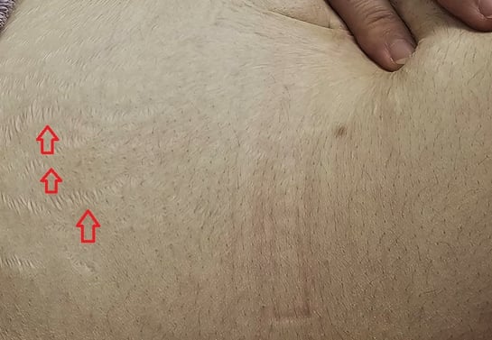 Abdominal stretch mark