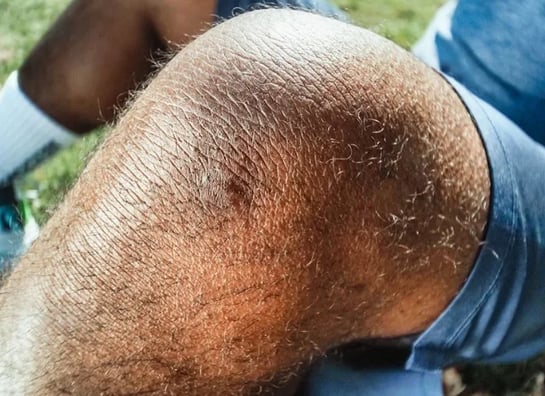 rotura de menisco dónde duele