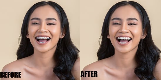 brace-removal