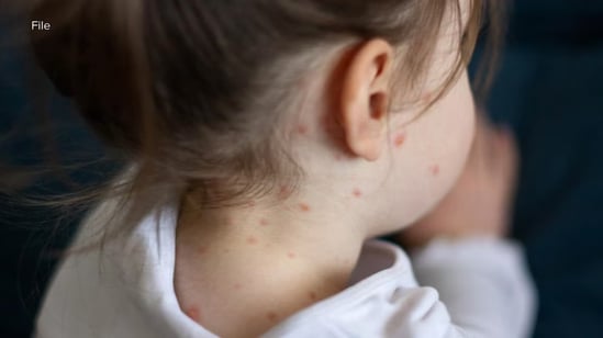 Texas Measles Outbreak
