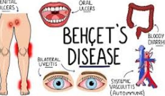 behçet's disease diagnostic criteria