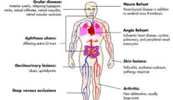 behçet's disease diagnostic criteria