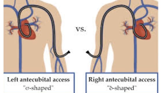 Cardiac Catheterization Why Every Case Is Followed by a Stent (3)