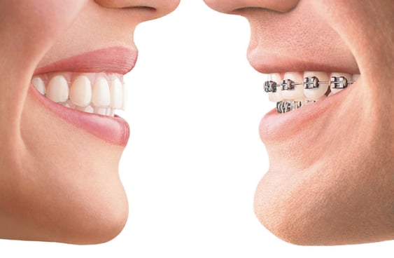 orthodontie alfortville Invisalign Dr Der Arminee