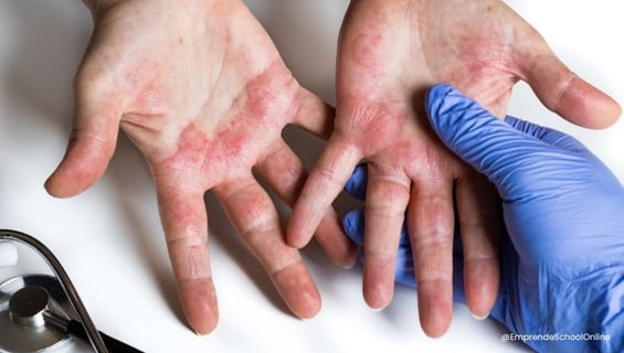 Enfermedades producidas por el polvo de uñas