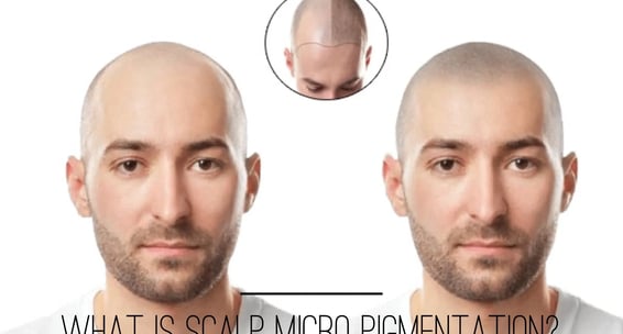 Skindent's Rejuvenate Scalp Micro Pigmentation Services