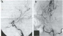 DSA in a TIA patient