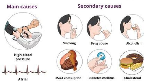 stroke causes