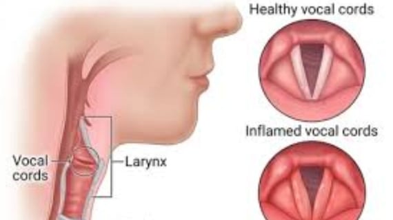 Laryngitis