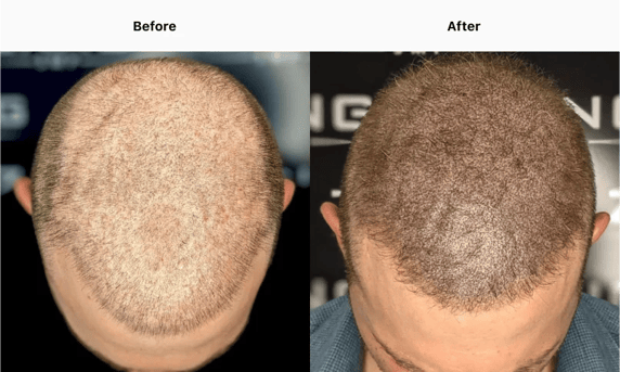 Best Scalp Micropigmentation Toronto_ATRUBARBER