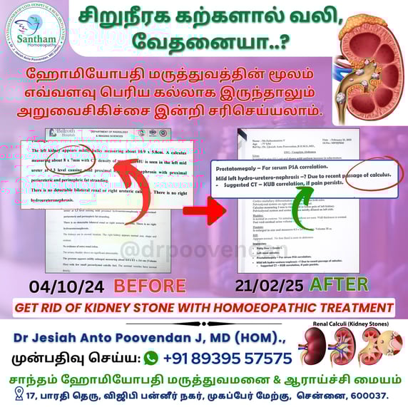 Kidney stone Homeopathic medicine