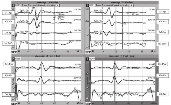 SSEP during intramed spinal cord tumours