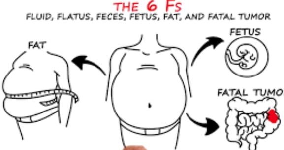 انتفاخ البطن : مجموعة متنوعة من العلاجات the 6 fs
