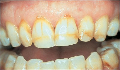 a image showing brown stains on teeth