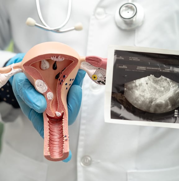 Fibroma uterino-terapia