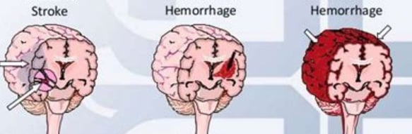 stroke types