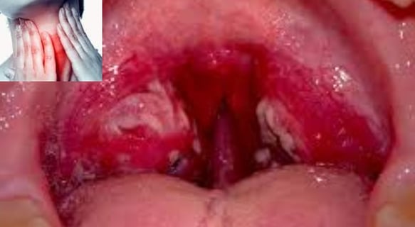 Dr. Hassan Al Warraqi's Approach to Disease Treatments Pharyngitis (Sore Throat)
