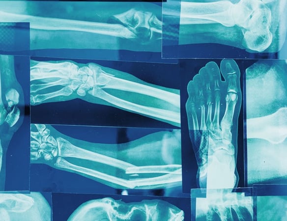 multiple overlapping blue x-rays of feet, legs, and arms