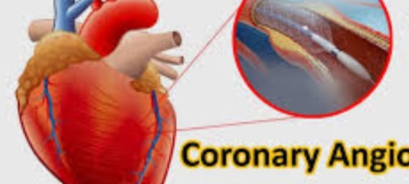coronary angioplasty