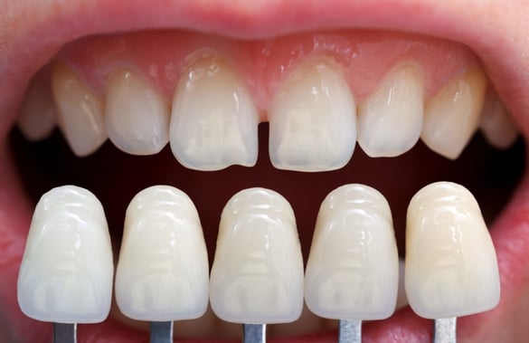fatete dentare protetica coroane punte lucrare proteza