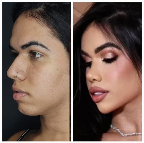 feminização facial frontoplastia