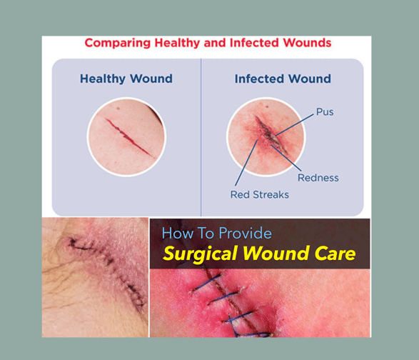 Surgical site infection