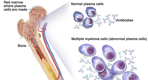 abnormal plasma cells