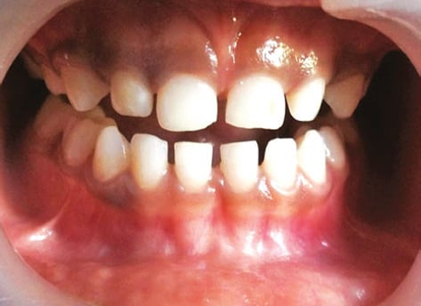 a image showing gap beween front teeth in mouth