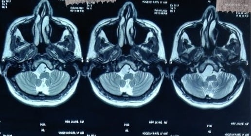 MRI Before Surgery - A gigantic Epidermoid tumour