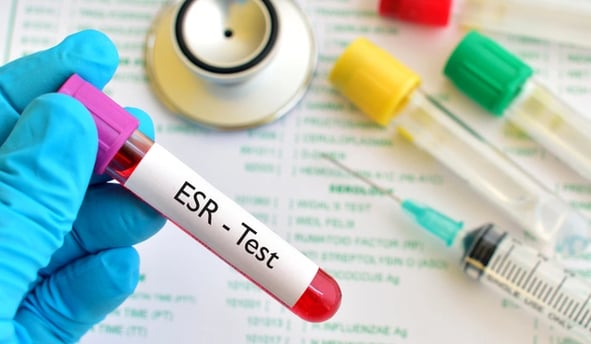 Sedimantasyon Nedir? Kan Testlerinde Yüksek ve Düşük Değerler