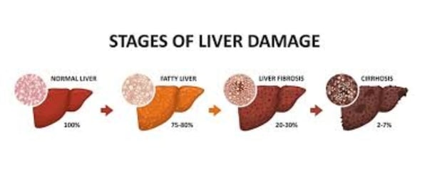 cirrhosis, esophageal varices and hepatoma